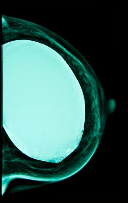 Los implantes interfieren con la detección temprana del cáncer del seno