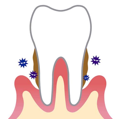 ¿Qué es la placa dental?