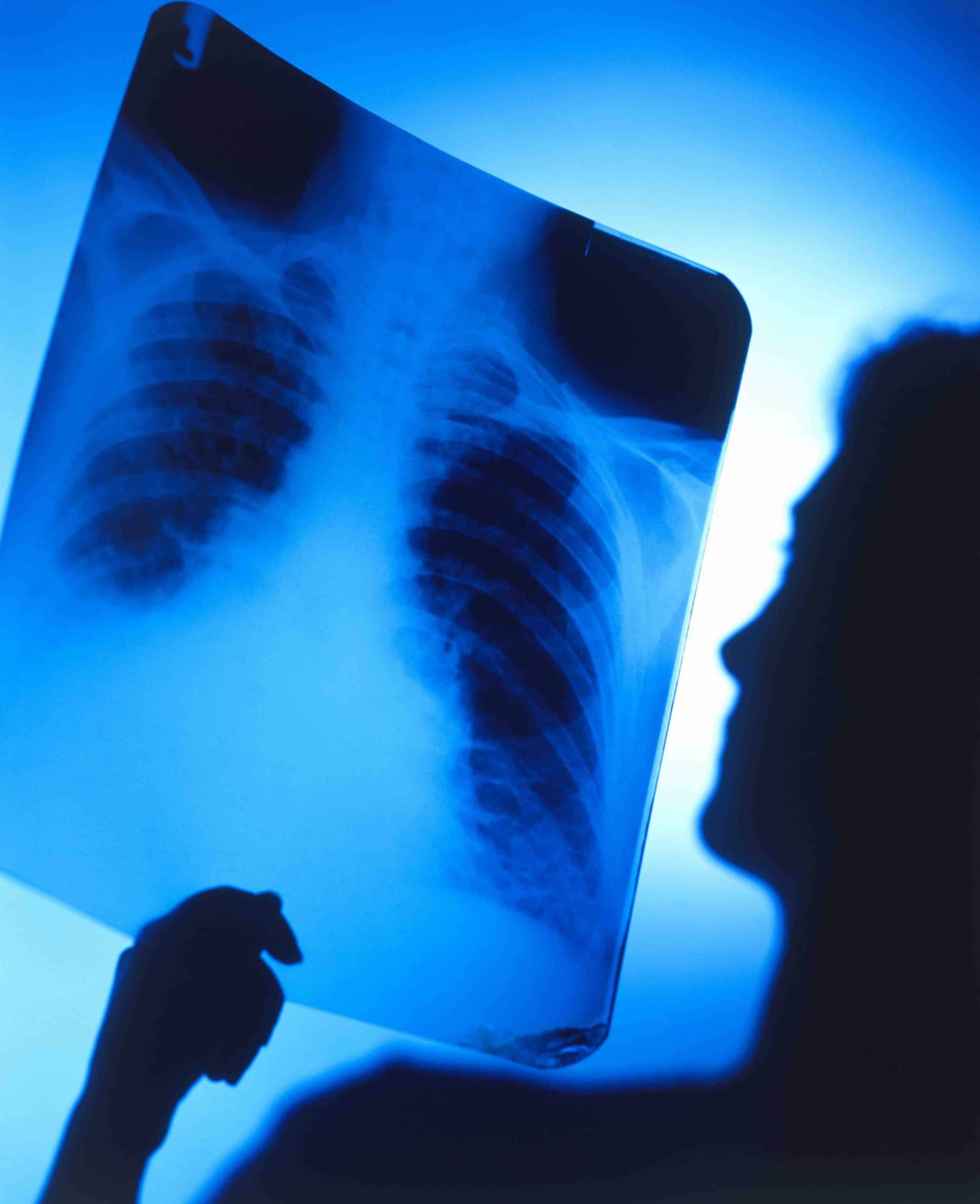 Fumar: la causa # 1 de cáncer del pulmón